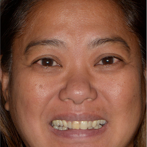 Smile Makeover - Jeannie - Before
